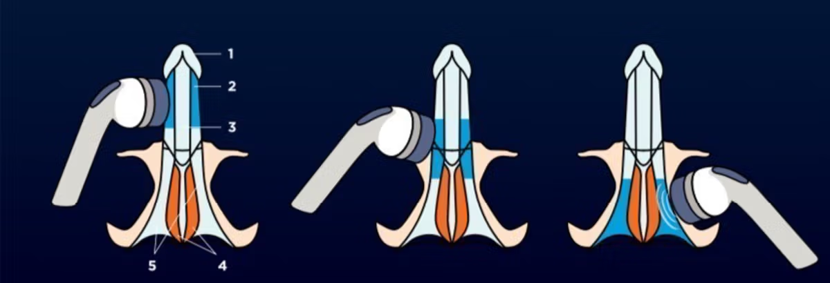 ภาพเปรียบเทียบ Smart Focus Shockwave